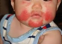 Kiwifruit Allergy in a Baby